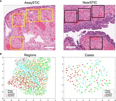 Focal Serous Tubal Intra-Epithelial Carcinoma Lesions Are Associated With Global Changes in the Fallopian Tube Epithelia and Stroma